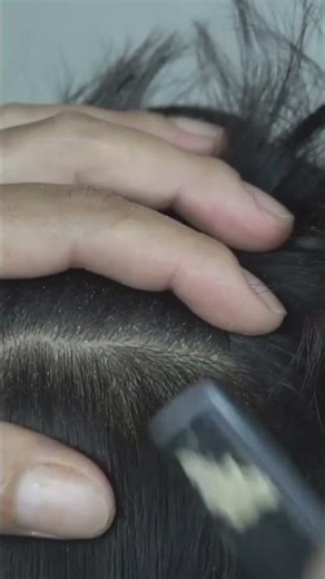 Quick and Easy Removing Scratching Big Dandruff Flakes