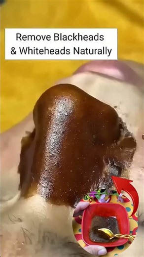 Remove Blackheads Permanently At Home Blackheads Removal Easy Tips ✨ Clear Glass Skin