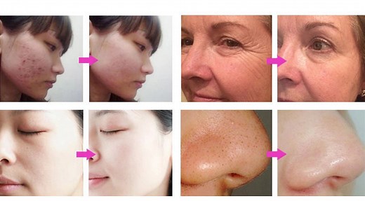 Tesla Violet Ray Tube High Frequency Device – Skin & Scalp Therapy - Natures Energies Health