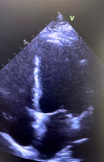Apical 4 chamber echocardiogram showing mild to moderate left ventricular systolic dysfunction