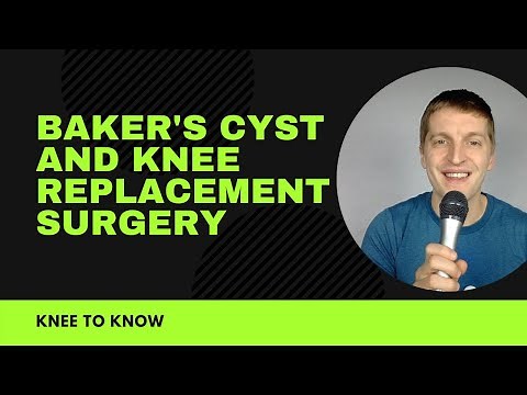Bakers Cyst and Knee Replacement Surgery