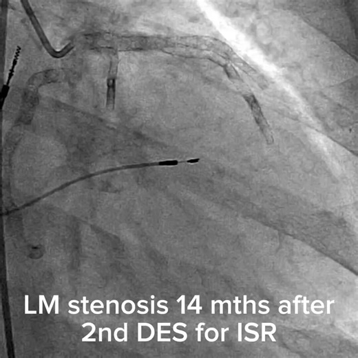 The fact that a 68 yo woman has had multiple PCIs over the last decade with pretty much the entirety of her coronary system stented tells me how badly the system has let patients down.Whomever did this needs to take a long hard look at themselves in the mirror- and ask themselves whether they were doing the best for the patient or their pocket.We need to do better. I very much doubt she wasn't a surgical candidate in her 50s / 60s