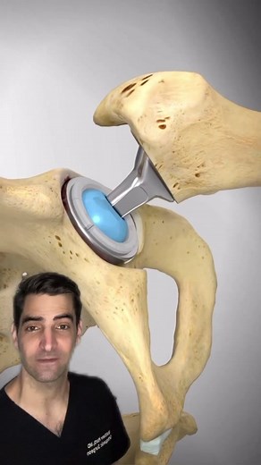 Minimally Invasive Hip Replacement Surgery by Orthopedic Surgeon