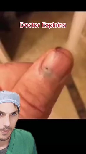 Most dark nail streaks are benign… but every now and then one turns out to be melanoma, which is cancer. If you're not sure what it is, have a dermatologist or hand surgeon check it out. #melanoma #melanonychia #fingernail #nails #cancer #dermatologist