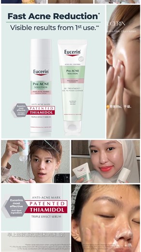 💬Real story. 💎 Real skin. ⚡Fast results. The Eucerin ProACNE Regimen works from Day 1 to visibly improve skin 💚 Fast Acne Reduction, Visible Results from 1st Use. 💚 Trusted by users | Clinically proven🧪 | Dermatologically tested 🩺 #EucerinMY #EucerinAcneExpert #LifeChangingSkincare #Dermatologicalskincare #Dermatologist #EucerinProAcne | Eucerin