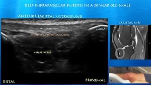 Deep Infrapatellar Bursitis in a 30 Year Old Male