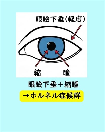 #Oculomotor nerve palsy #Horner's syndrome #Differential diagnosis of ptosis #Pupillary dilation ...