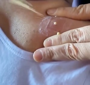 Pimple Popping Videos on Instagram: "Back pimple explosion 💥 🏷: #pimple #pimplepopping #pores #pimplepop #pimples #acne #blackheads #whiteheads #blackheads #blackheadremover #blackhead"