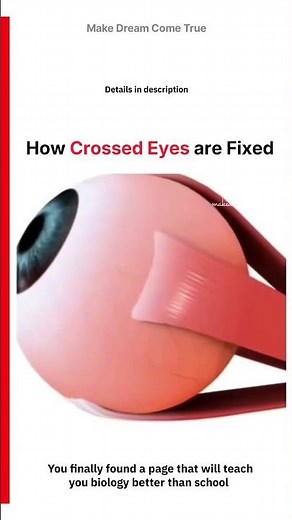 👁️ How Crossed Eyes are Fixed 📏 | MDCT