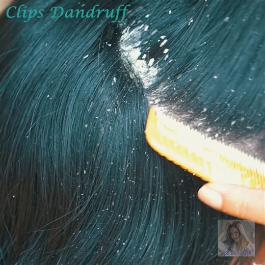 A Complete Guide to Scalp Care for Dandruff Solutions! 416 | Clips Dandruff