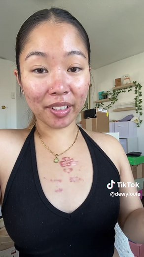 Keloid Scar Removal & Treatment Update