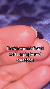 MandelAC serum works like magic for acne prone skin!! MandelAC serum containing 20% Mandelic Acid is a perfect everyday exfoliant for acne prone skin. 94% saw even skin tone and texture with no scarring. 94% saw reduced post-breakout dark spots. 94% saw reduced hyperpigmentation. Clinically proven to reduce pimples Chemically exfoliates dead skin cells. #jenpharm #skincare #trending #viral #instagram #trending #fyp #foryoupage #skincare #skin #mandelicacid #comedonalacne #comedons | Jenpharm Lif