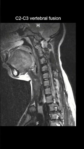 C2-C3 vertebral fusion with Scoliosis Sagittal Coronal T2 #MRI #Radiology #Shorts