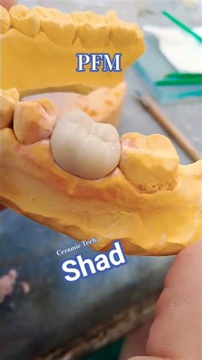 PFM Case 💞🖌️ #shorts #exocad #pfm #teethdecay #dentist #teeth