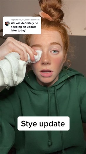 Stye Update: Treatment Progress and Remedies for Eye Health