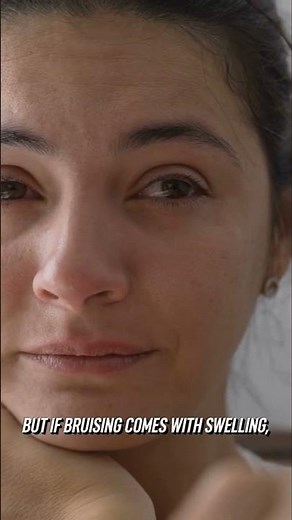 Bruising After Tooth Extraction? What’s Normal vs. When to Call Your Dentist