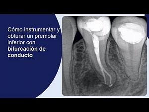 How to instrument and obturate a mandibular premolar with a bifurcated canal