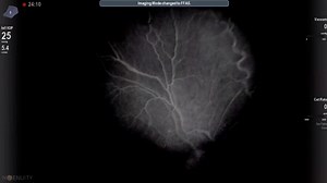 3D Intraoperative Angioscopy - Eyetube