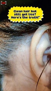Head lice are not about dirty or clean hair. It’s about awareness. Don’t get it wrong anymore 👀 Still believe head lice only live in dirty hair? Let’s start this January with facts, not myths. Small education can prevent big problems ✨ #HeadLiceFacts #LiceAwareness #HairHealth #HealthyScalp #EducationalContent #Positivity #Positivevibes | Ahmad