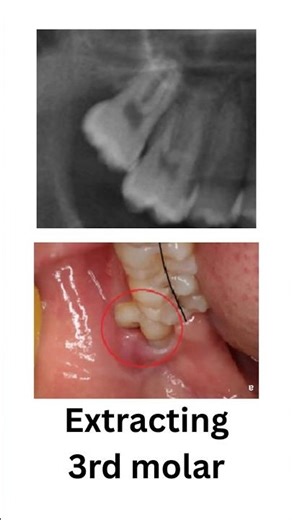 Upper wisdom tooth (8 extraction