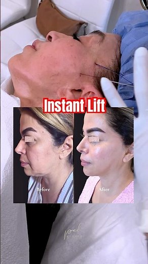 PDO Threadlift: One Year Later