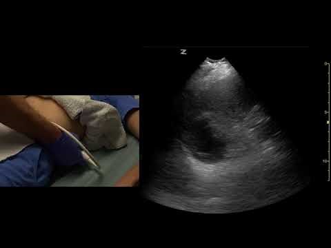 Left Upper Quadrant Abdomen, Coronal Views, Ultrasound Scanning Techniques