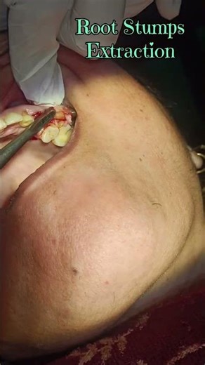 Root Stumps Extraction. #dentist #smiledesigndental #invisiblebraces #dentalclinic
