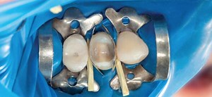 Dental Isolation: Objectives and Applications in Dentistry