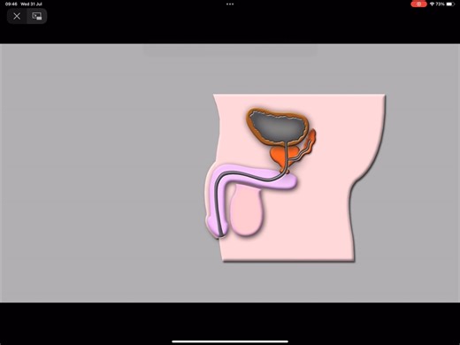 Urethral stricture video