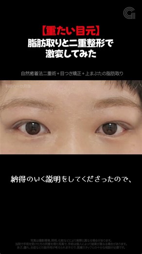 二重まぶたと目の脂肪除去を一緒にすると、こんな感じになる！