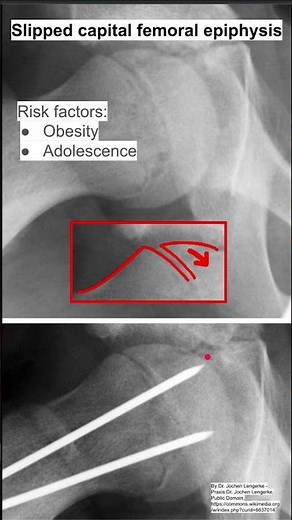Slipped capital femoral epiphysis