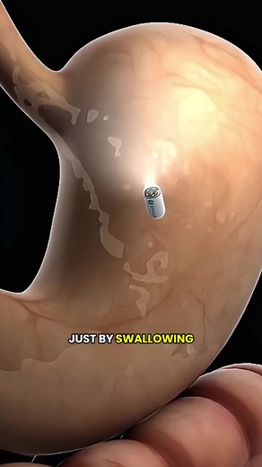Understanding Capsule Endoscopy: Procedure and Preparation