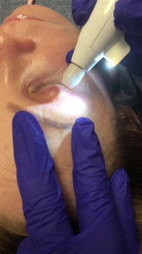 👀 THIS $800 TREATMENT CAN REPLACE EYELID SURGERY — We were the first in Florida to bring this European innovation to our clients nearly 10 years ago. Plasma Exeresis works by creating micro-heat that cause skin to contract and tighten plus add 30% more collagen — its science-backed skin renewal that truly delivers. ✨ No anesthesia ✨ No surgery ✨ No scars Just brighter, tighter, more youthful eyes. 💸 $800 through December | $999 starting January Book your lift before the price goes up! TONS of 