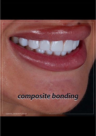 Understanding Dental Bonding for a Perfect Smile