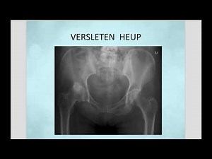 Wat is het verschil tussen een versleten en een gezonde heup? | Orthopeed Jan Ide de Jong
