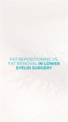Yao Wang, MD on Instagram: "Many patients come in asking about lower lid fat bags and what can be done. There are two main approaches: fat excisionor fat repositioning. If you have noticeable fat bags but no deep hollow under your eyes, we can remove a bit of fat from the inside of the eyelid. This smooths the lower lid, is relatively straightforward, and has a shorter healing time. If you have both prominent fat bags and hollows — which is common as we age — we can take the fat and reposition i