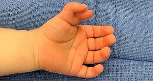 Polydactyly: Common Extra Digits Mutation