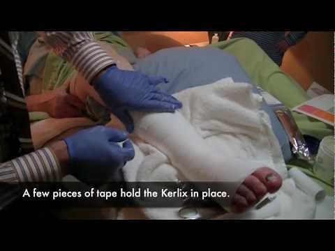 Dr. Bruce Ruben, Wound Care Expert.mov