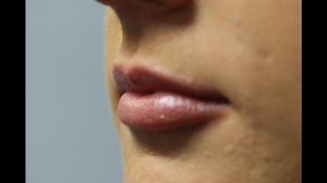 Before & After Restylane Silk: Subtle Lip Lift