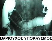 Παθήσεις Παχέος Εντέρου - Γενικός Χειρουργός Α. Ξιάρχος