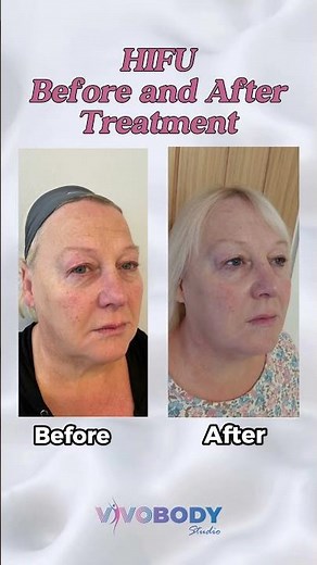 BEFORE AND AFTER HIFU TREATMENT #hifu #hifutreatment #hifufacial