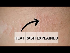 Heat Rash