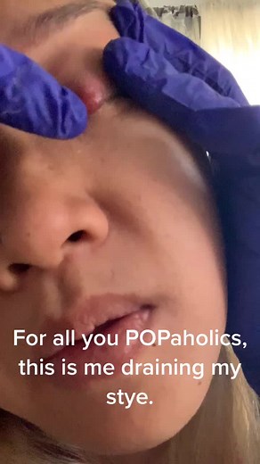 For all you POPaholics, this is me draining my stye. #popaholic #pimplepopping