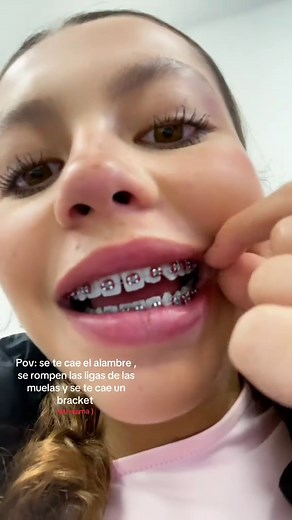 Colores de Brackets: Cuidados y Consecuencias