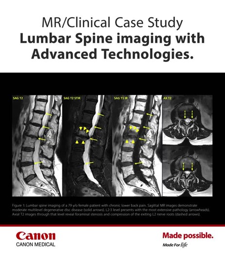 UC San Diego study: AiCE, SPEEDER, Exsper, and CS improve spine MRI visualization | Canon Medical Systems USA, Inc. posted on the topic | LinkedIn