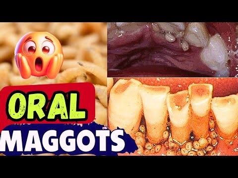 Shocking Visual: Mouth Full of Maggots : Oral Myiasis Causes, Treatment, and Prognosis 🪱🦠