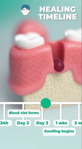 🦷 Tooth Extraction Healing Timeline: What to Expect