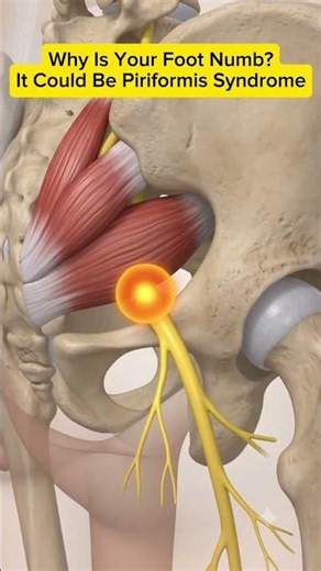 Why Is Your Foot Numb? It Could Be Piriformis Syndrome