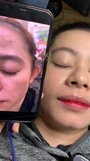 Cập nhật Da Sạm Nám#chamsocdamun#chamsocdaseo#chamsocdanam#tanbinh#Lqspa&academy