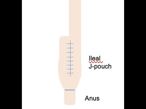J-Pouch Surgery Explained - With Diagrams!